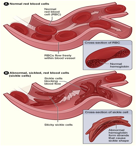 Sickle Cell Anemia and its Prevention| Biology Science Fair Project Ideas